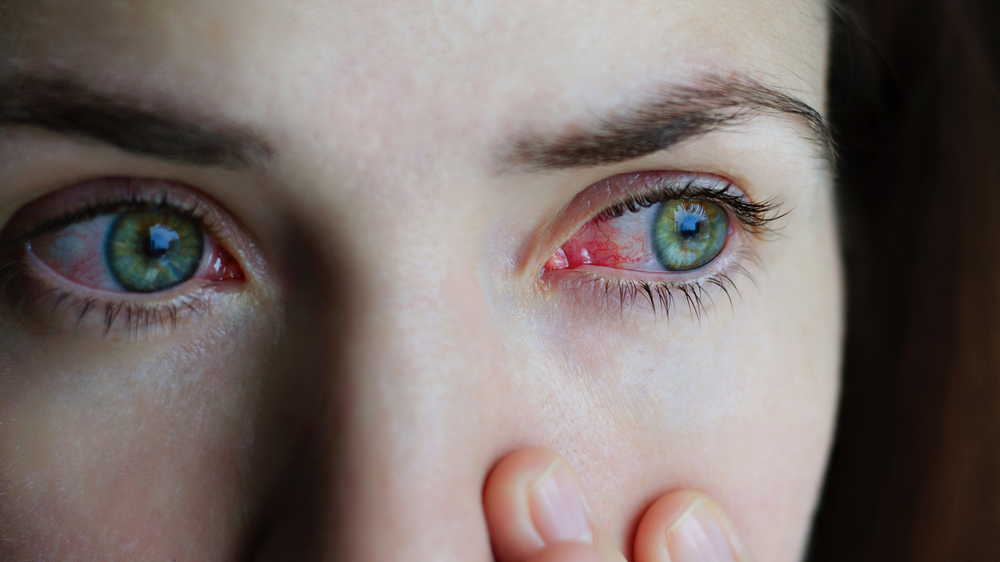 Red Eye Treatment